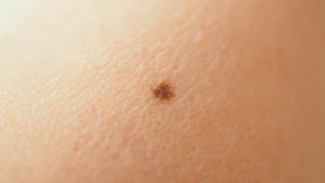 【画像】脚に癌みたいなのできたｗｗｗ → ヤバすぎる事実が発覚しスレ騒然