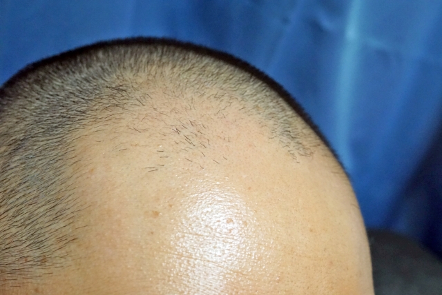 【朗報】ハゲ、やはり最強だった